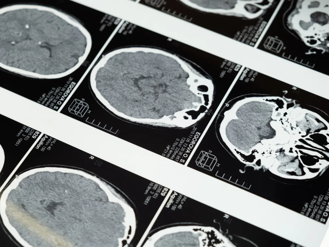 Brain scan showing a brain injury